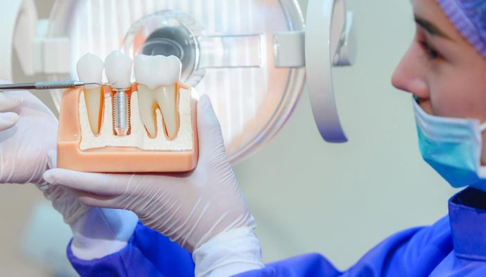 Dental-implants3