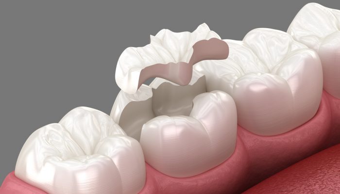 Inlay ceramic crown placement. Medically accurate 3D illustration of human teeth treatment
