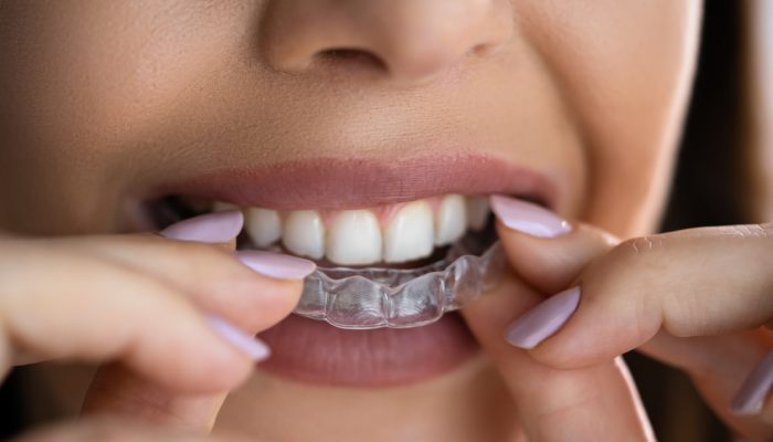 Clear Aligner Dental Night Guard For Teeth