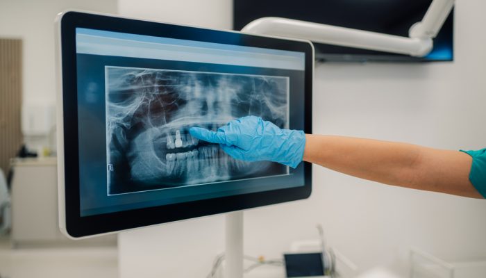 Dentist examining a dental x-ray on a digital monitor, highlighting a specific area of the teeth