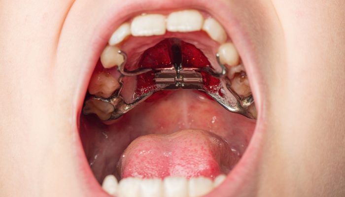 Palatal expander dental device in mouth. Medical and orthodontic equipment inside oral cavity.