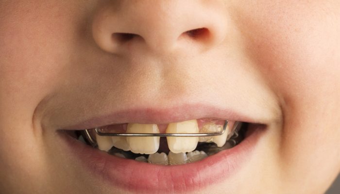 Closeup of smiling little girl wearing an orthodontic dental apparatus for correcting the position of teeth